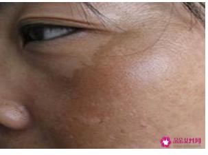 肝斑的症状是什么