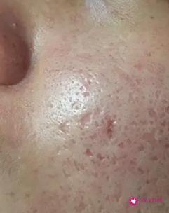 脸上为什么会有坑坑洼洼的怎么消除