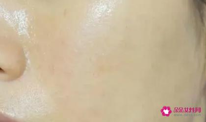 油性皮肤去痘痘的方法