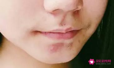 油性皮肤去痘痘的方法