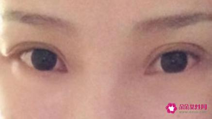 双眼皮是做平行还是开扇形