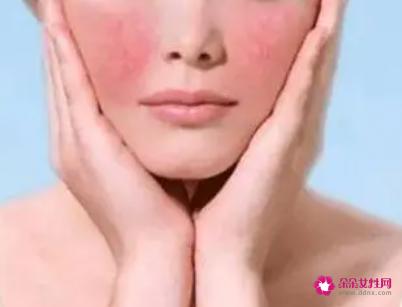 脸颊红血丝如何改善
