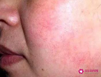 脸颊红血丝如何改善
