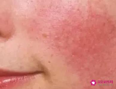 脸颊红血丝如何改善