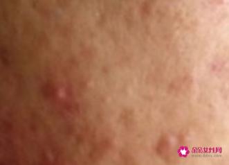 小学生脸上长痘痘如何消除