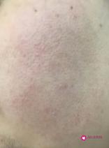 油脂性痤疮怎么办