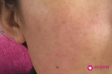 脸部长斑的原因是什么