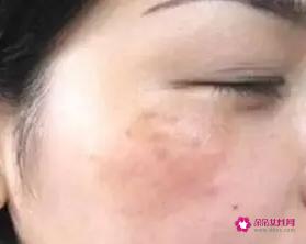 脸部长斑的原因是什么