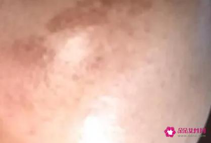 脸部长斑的原因是什么