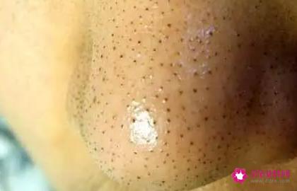 黑头粉刺怎么去除最有效