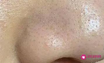 黑头粉刺怎么去除最有效