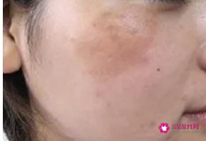 面部色斑是怎么形成的原因