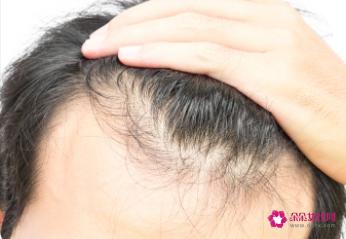 发际线可以自行恢复吗