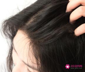 发际线可以自行恢复吗