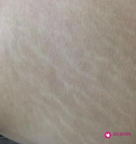什么是肥胖纹图片