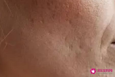 毛孔粗大的原因是哪些