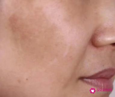 怎么样才可以把脸上的斑去掉