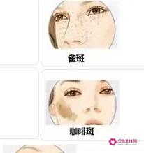 色素斑是怎么形成的呢