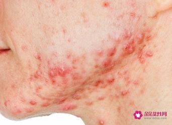 粉刺是什么样子