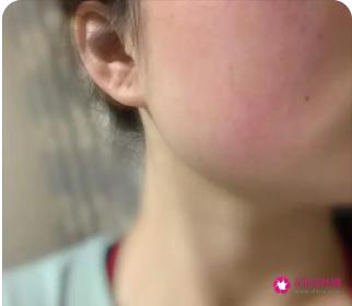 皮肤敏感发红发热怎么补救