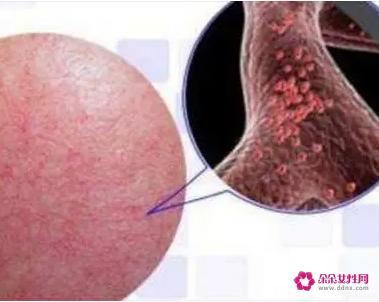 皮肤敏感发红发热怎么补救