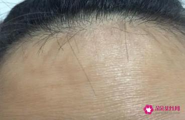 额头皮肤松弛有皱纹怎么办