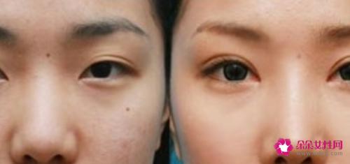 做双眼皮手术有哪几种方法
