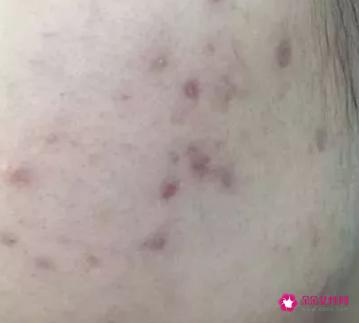 教你4个淡化痘印的有效方法