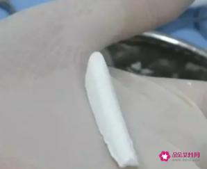 隆鼻想长久建议硅胶还是膨体