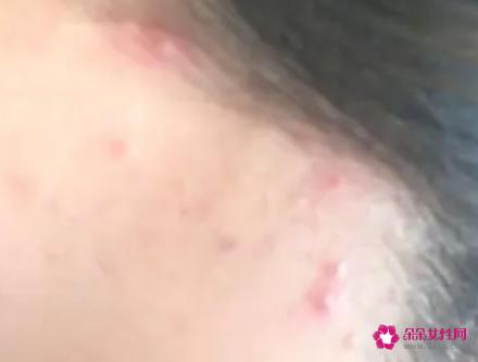 太阳穴长痘的原因是什么