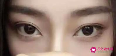 双眼皮有几种种类