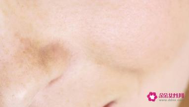 女生脸部毛孔粗大是怎么回事
