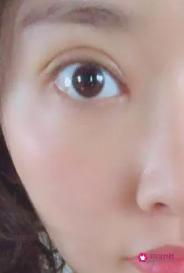 我是内双眼皮可以做双眼皮手术