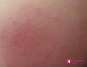 春季脸上有皮癣是什么原因