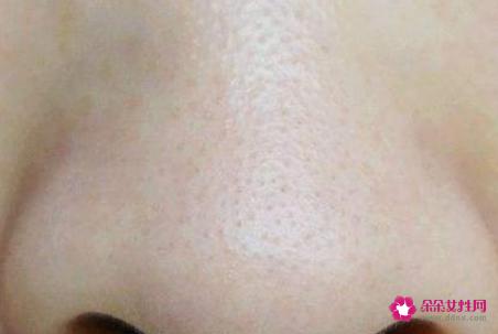 去黑头的小窍门有哪些