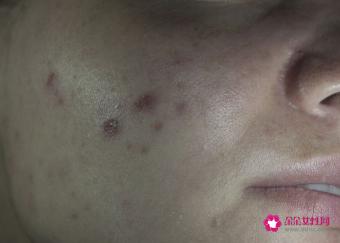 哪种去痘痘产品最好