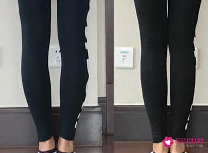 男人罗圈腿适合什么裤子图片