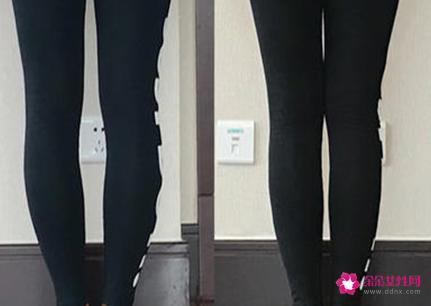 o型腿的人适合穿什么裤子