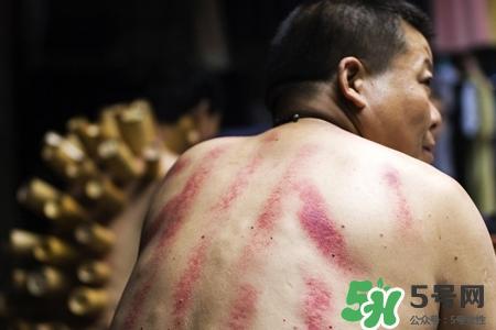 背部刮痧后能拔火罐吗？背部刮痧后拔火罐有什么好处？