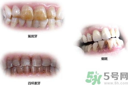 四环素牙是什么?四环素牙是怎么形成的?