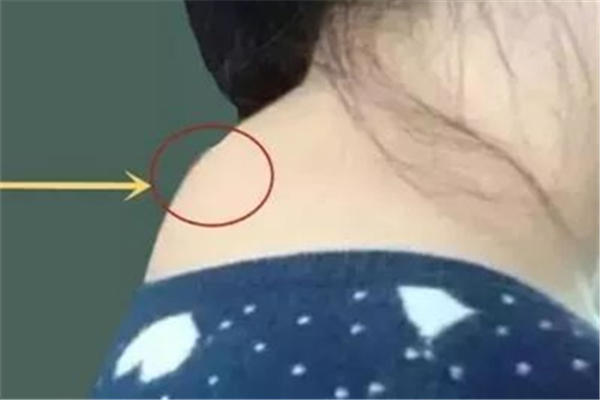 富贵包是什么原因引起的 富贵包可以抽脂消除吗