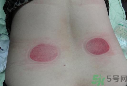 拔火罐可以减肥吗?拔火罐能减肥吗?
