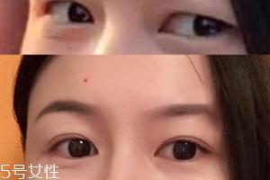 内双怎么进化成双眼皮?全是双眼皮贴的功劳