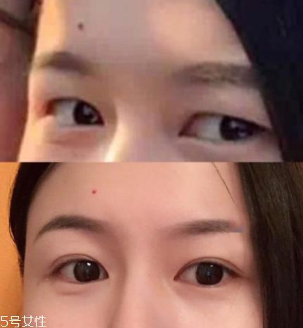 内双怎么进化成双眼皮？全是双眼皮贴的功劳