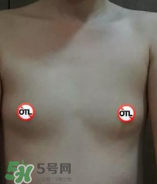 假体隆胸取出后悔死了 假体隆胸取出后图片