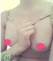 假体隆胸取出后悔死了 假体隆胸取出后图片