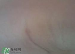 假体隆胸取出后悔死了 假体隆胸取出后图片