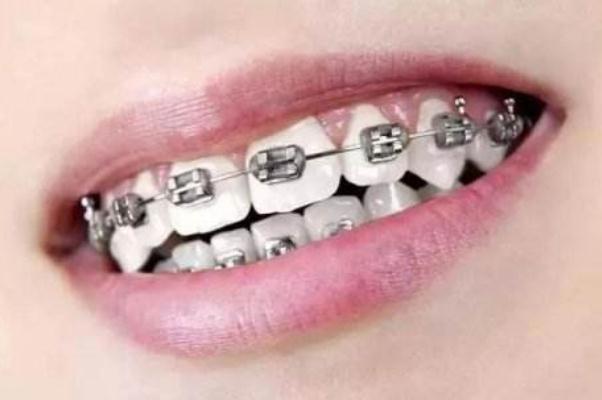 牙套的种类和价格 牙套价格一般是多少钱一个