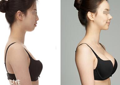 注射丰胸的危害有哪些 自体脂肪丰胸后怎样护理效果最好