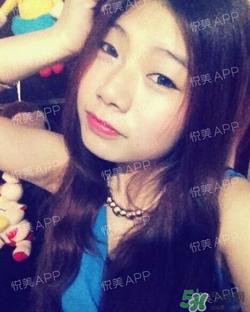 切开双眼皮消肿过程图_切开双眼皮恢复过程图